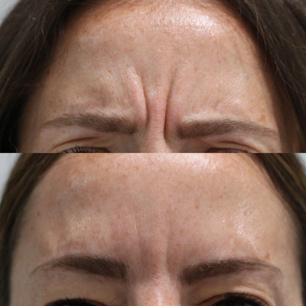 Botox Before and After Photo by Liv Aesthetics Medical Spa in New Fairfield, CT