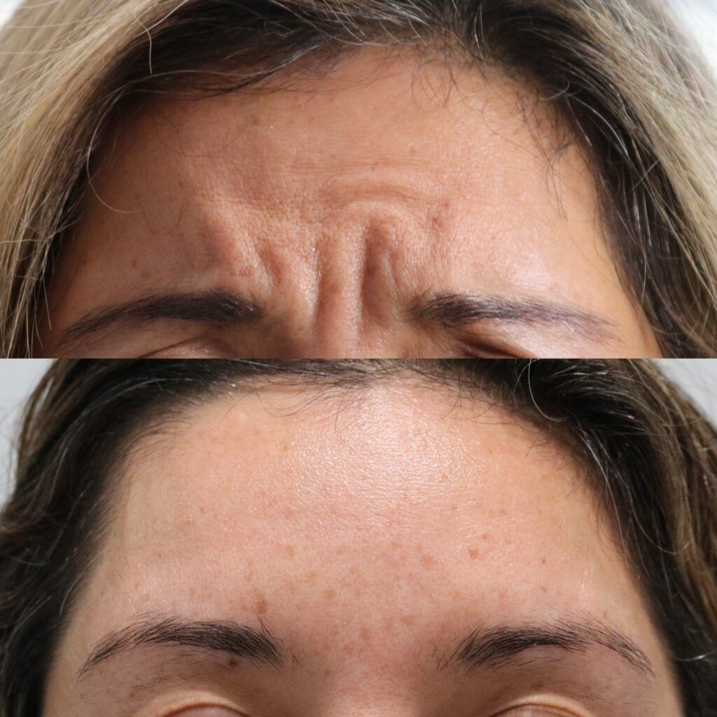 Botox Before and After Photo by Liv Aesthetics Medical Spa in New Fairfield, CT