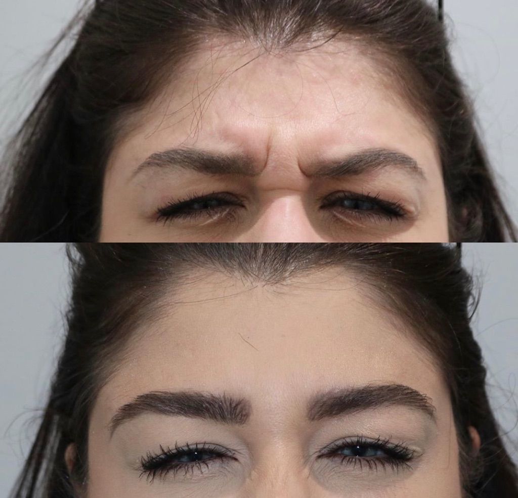 Botox Before and After Photo by Liv Aesthetics Medical Spa in New Fairfield, CT