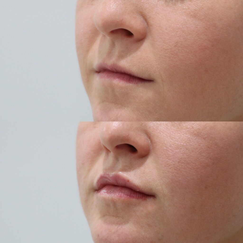 Lip Fillers Before and After Photo by Liv Aesthetics Medical Spa in New Fairfield, CT