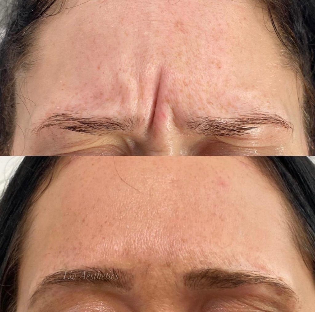 Botox Before and After Photo by Liv Aesthetics Medical Spa in New Fairfield CT