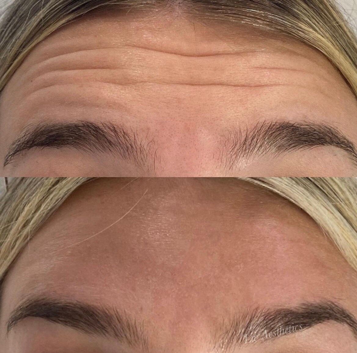Botox Before and After Photo by Liv Aesthetics Medical Spa in New Fairfield CT Botox Before and After Photo by Liv Aesthetics Medical Spa in New Fairfield CT