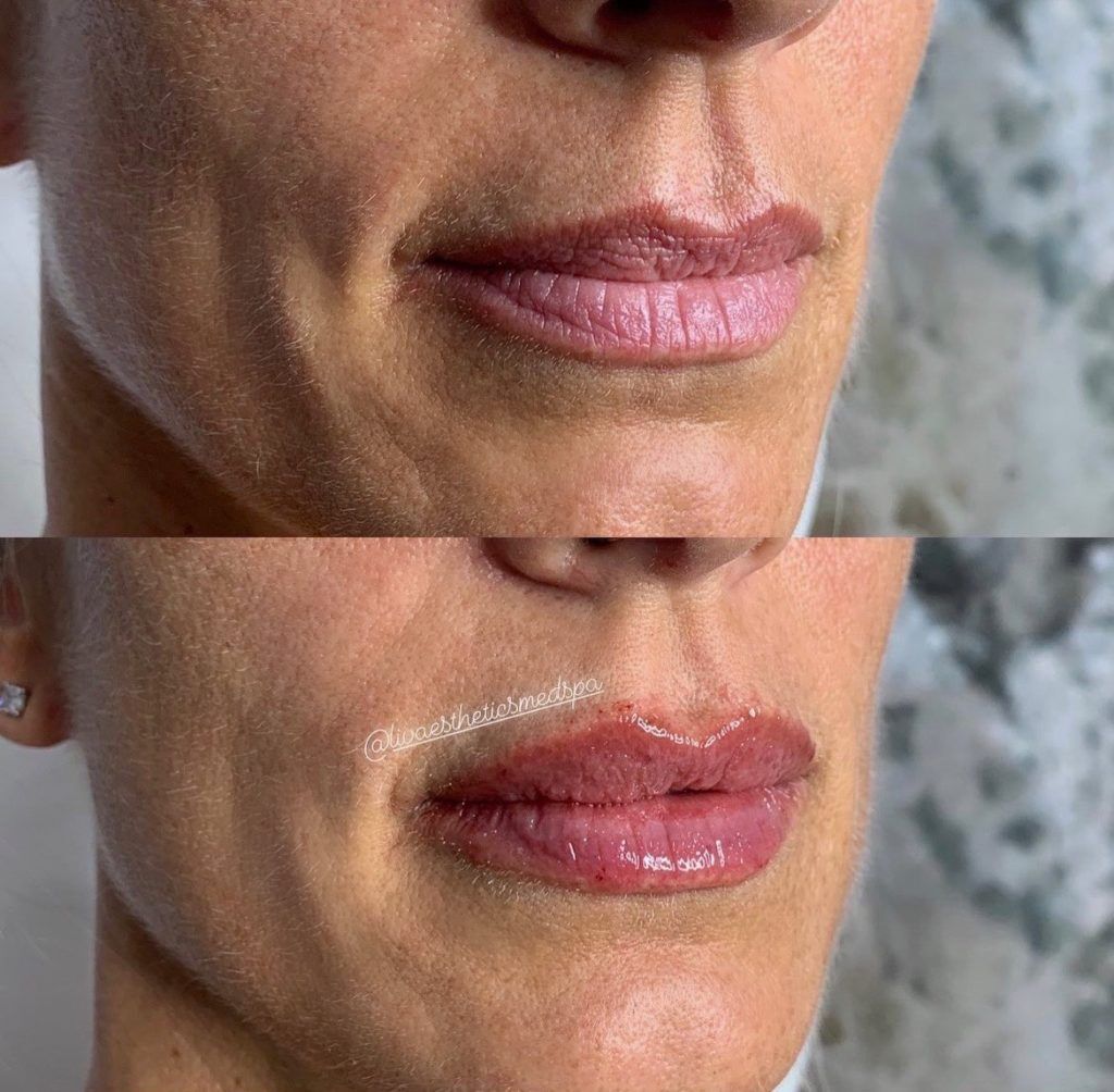 Lip Fillers Before and After Photo by Liv Aesthetics Medical Spa in New Fairfield CT