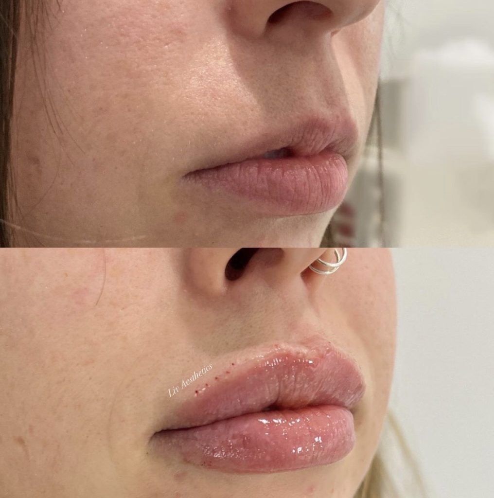 Lip Fillers Before and After Photo by Liv Aesthetics Medical Spa in New Fairfield CT