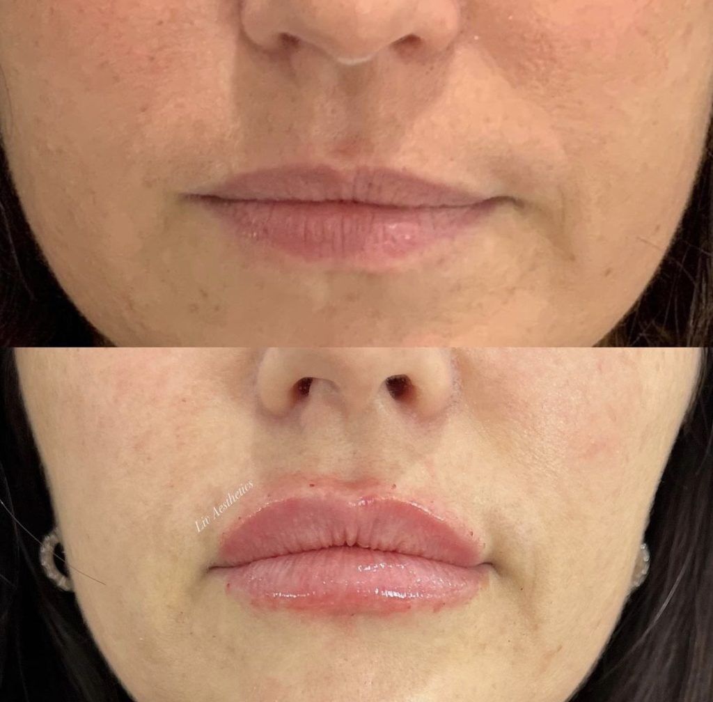 Lip Fillers Before and After Photo by Liv Aesthetics Medical Spa in New Fairfield CT