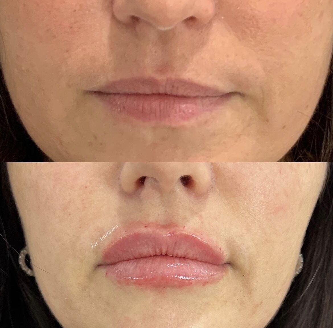 Lip Fillers Before and After Photo by Liv Aesthetics Medical Spa in New Fairfield CT Lip Fillers Before and After Photo by Liv Aesthetics Medical Spa in New Fairfield CT