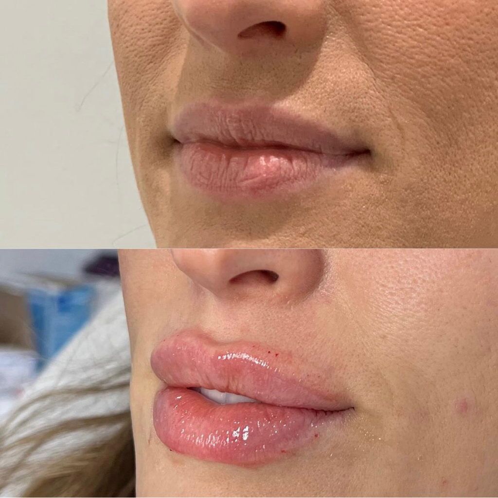 Lip Fillers Before and After Photo by Liv Aesthetics Medical Spa in New Fairfield CT