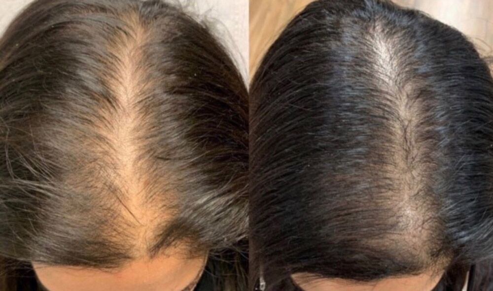 keralase before and after image keralase before and after image