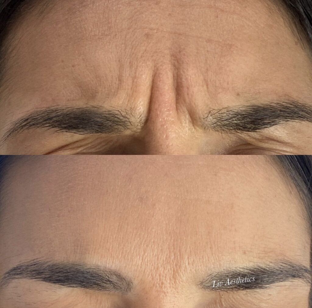 Botox before and after photo by Liv Aesthetics Medical Spa in New Fairfield, CT