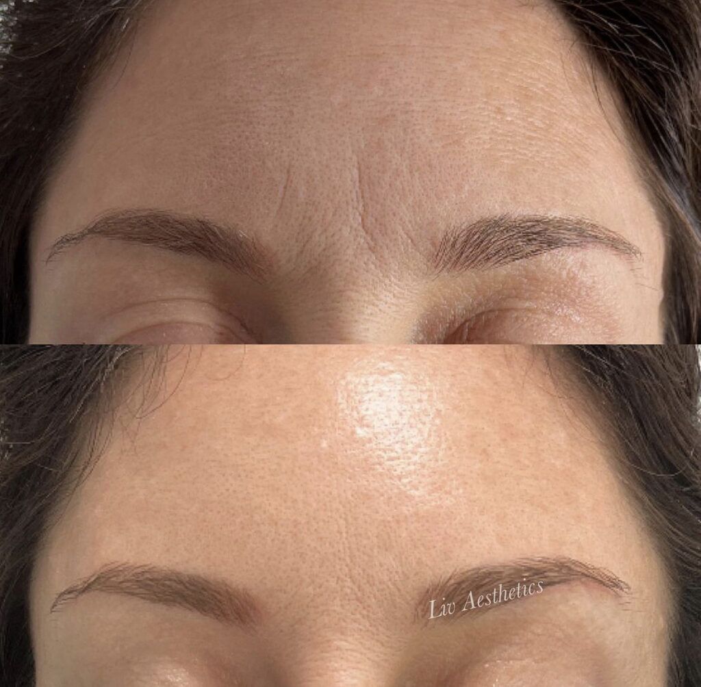 Botox before and after photo by Liv Aesthetics Medical Spa in New Fairfield, CT
