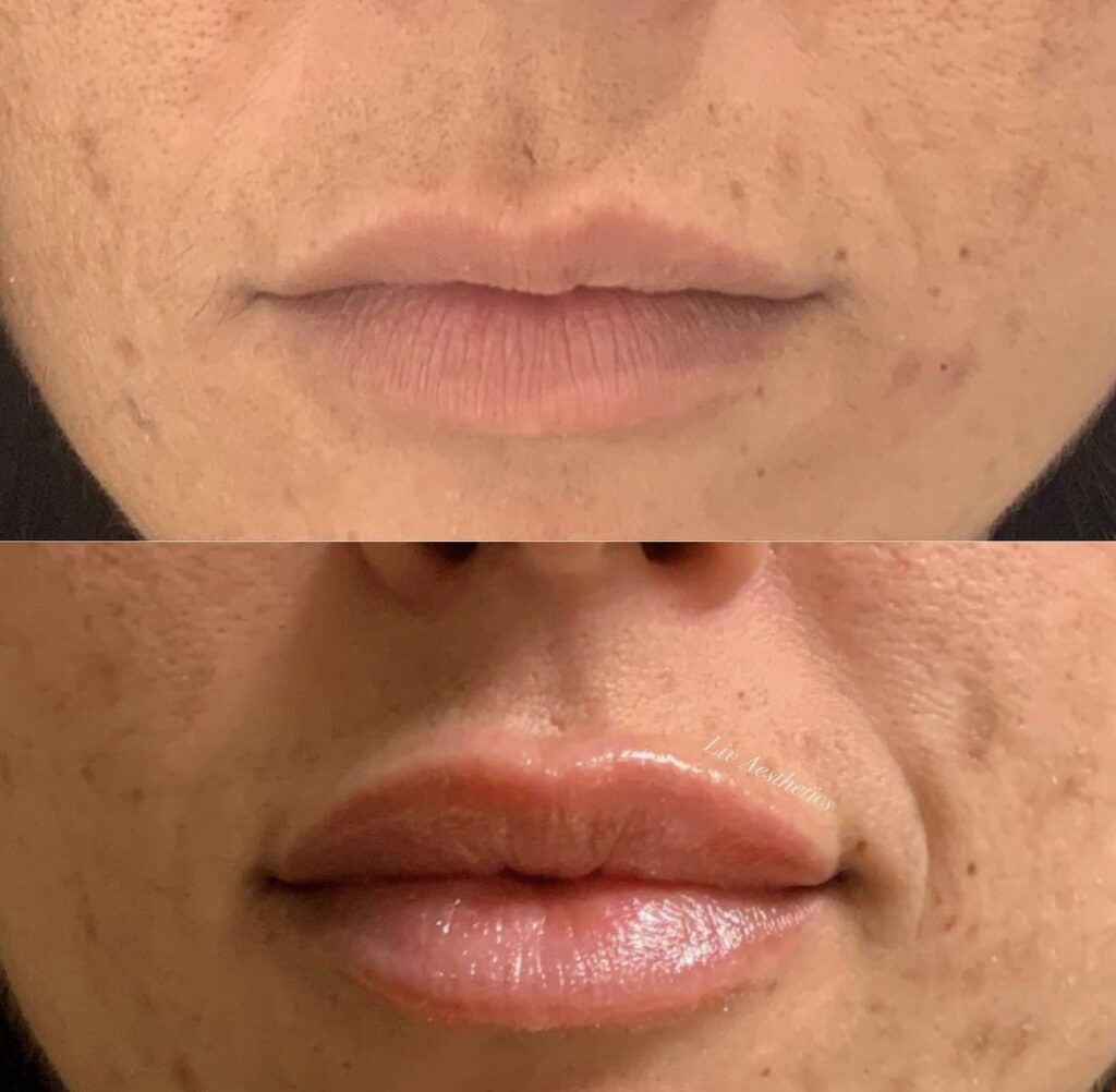 Lip Fillers before and after photo by Liv Aesthetics Medical Spa in New Fairfield, CT