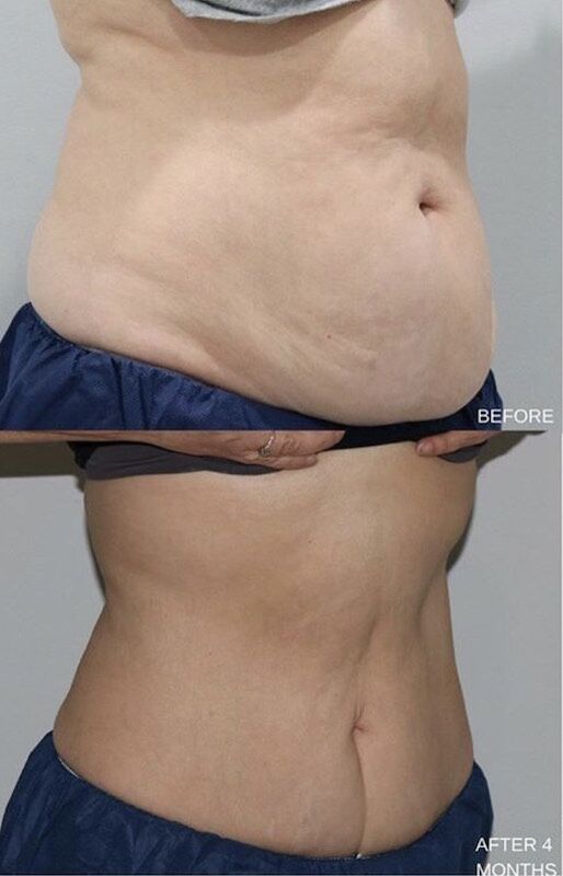 CoolSculpting before and after results CoolSculpting before and after results